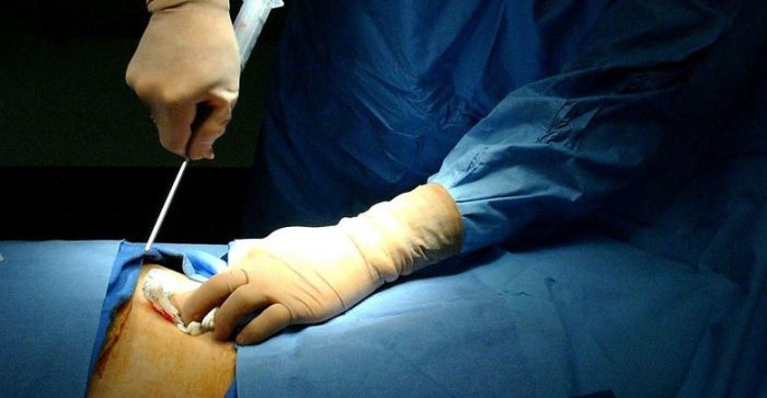 نخستین عمل موفق پیوند مغز استخوان در استان کردستان